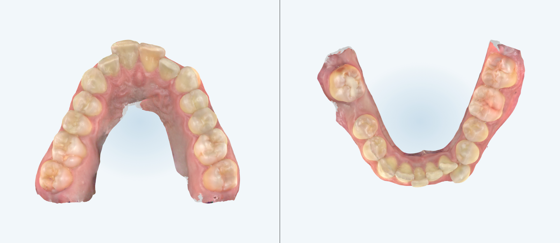 Crowding treatment comparison case 1 before